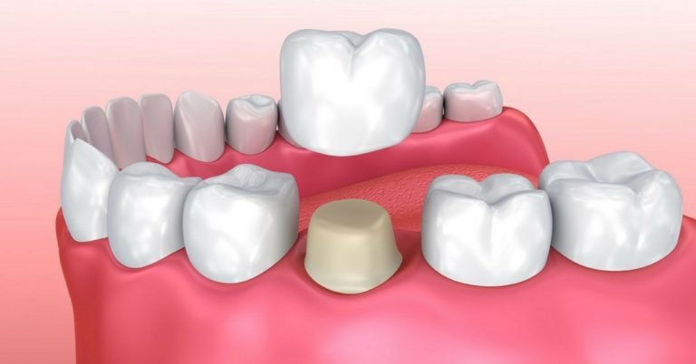 dental_crown_indications_sm