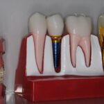 dental-science-introduce-protocolul-fast-fixed-bredent-dantura-fixa-pe-implanturi-in-24-de-ore-pentru-pacien-ii-care-au-pierdut-to-i-din-ii-in-sector-6-bucure-ti1