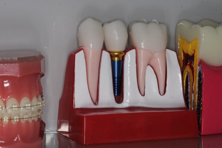 dental-science-introduce-protocolul-fast-fixed-bredent-dantura-fixa-pe-implanturi-in-24-de-ore-pentru-pacien-ii-care-au-pierdut-to-i-din-ii-in-sector-6-bucure-ti1
